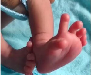 Pictures of Indian baby born with 26 fingers and toes surfaces online