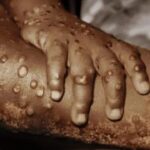 WHO declares Monkeypox global health emergency