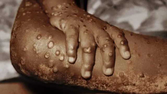 WHO declares Monkeypox global health emergency