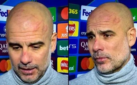 “I Chose to Cut Myself” – Pep Guardiola Explains Cuts on His Face After Manchester City’s 3-3 Draw with Feyenoord