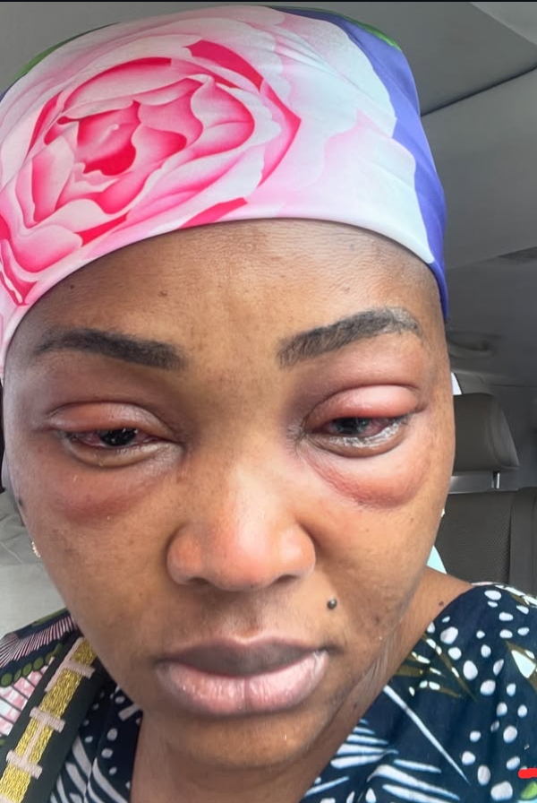 Mercy Aigbe Recounts Harrowing Eye Infection Experience on Set of Thin Line